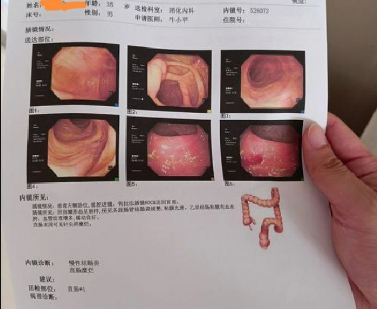 结肠炎的症状和治疗有哪些