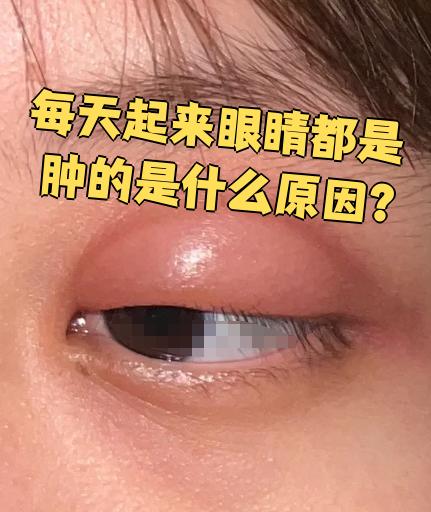 早上起来眼睛肿了,怎么办.