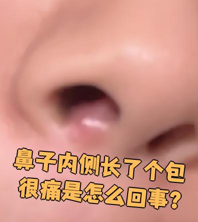 鼻前庭囊肿会自己消吗?