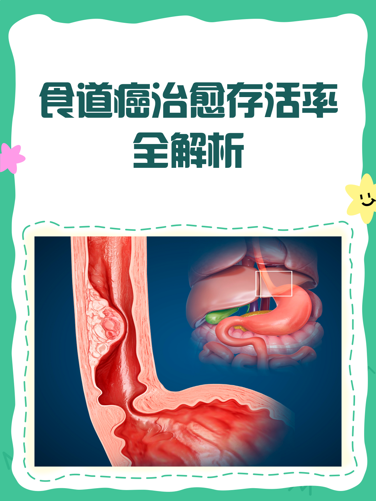 食道癌术后大约可以活多久