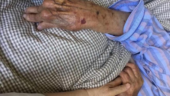 一氧化碳中毒后遗症有哪些?