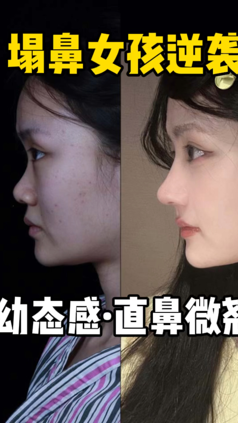 鼻子塌陷怎么办