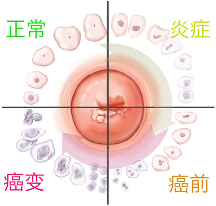 低级别鳞状上皮内病变lsil严重吗