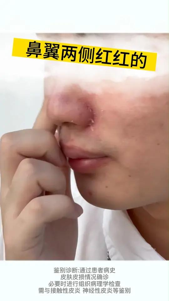 鼻子两边发红怎么回事