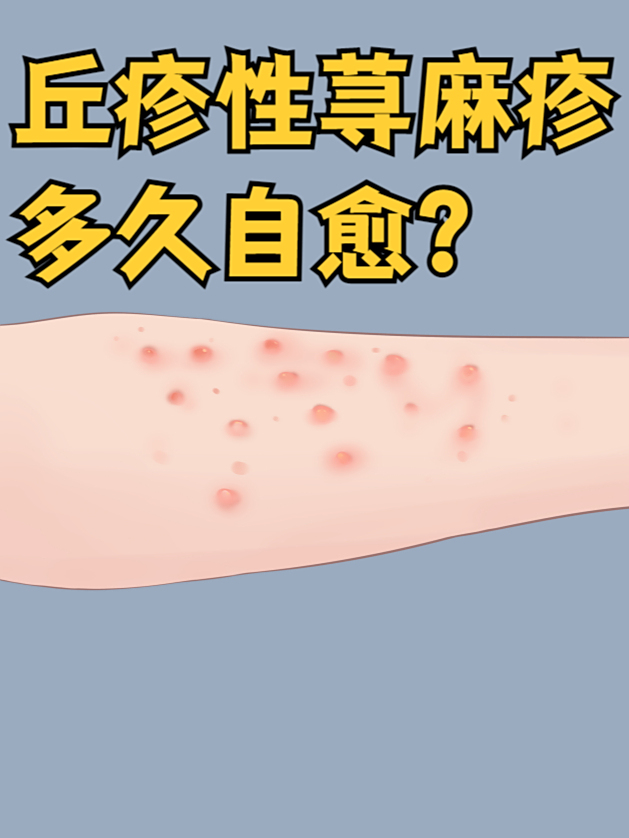 什么是压迫性荨麻疹?