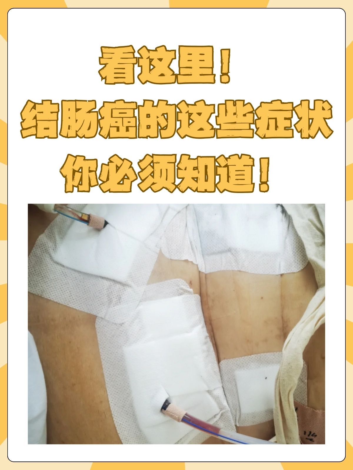 结肠癌什么原因导致的?