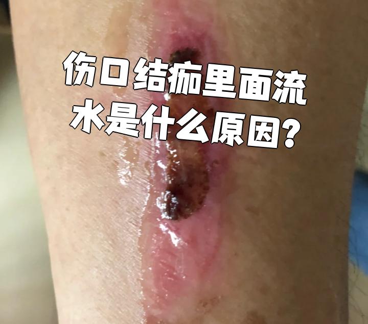 伤口结痂以后能碰水吗