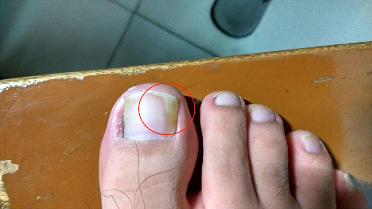 脚指甲变厚发黄是什么原因?