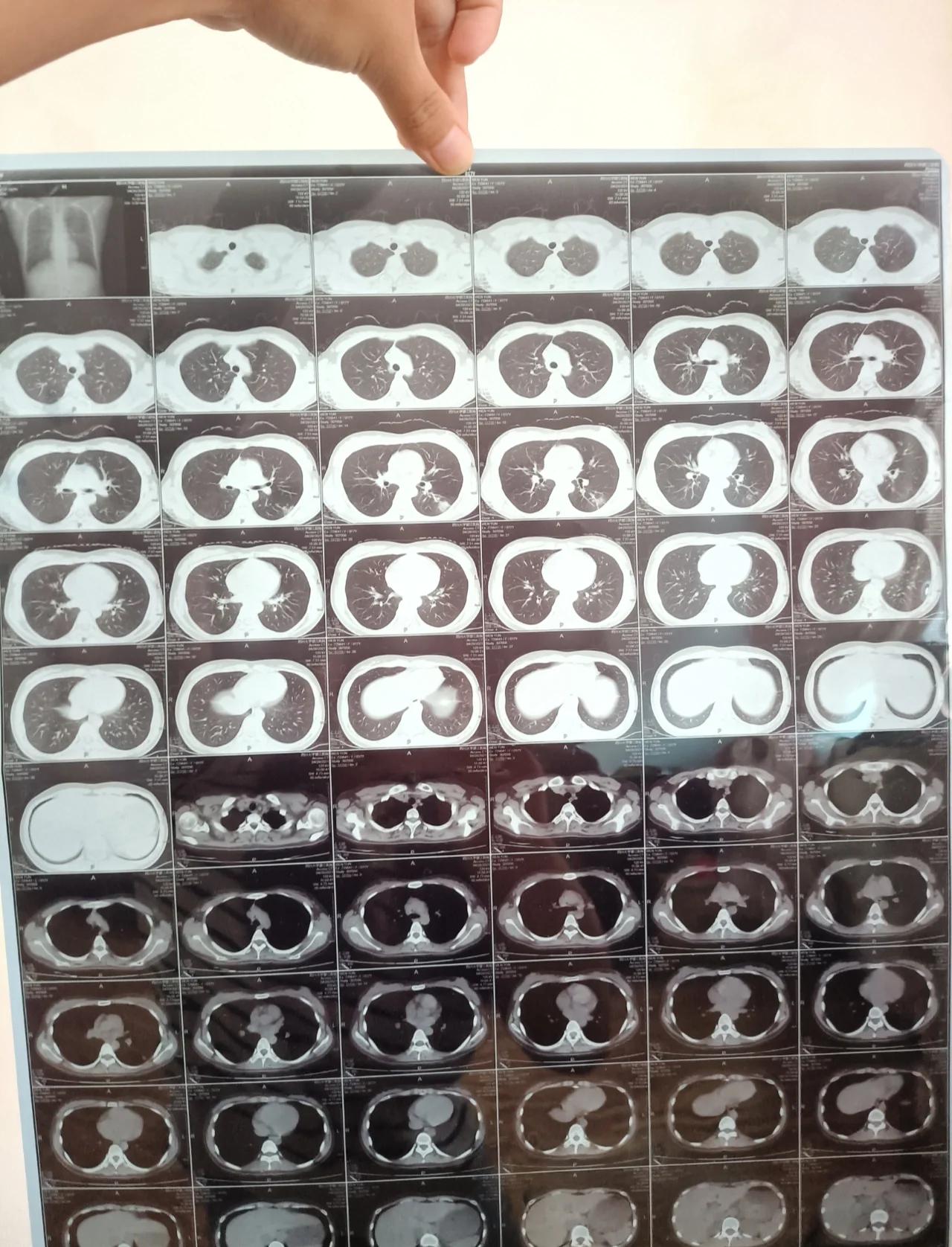 肺结核拍胸片能看出来吗