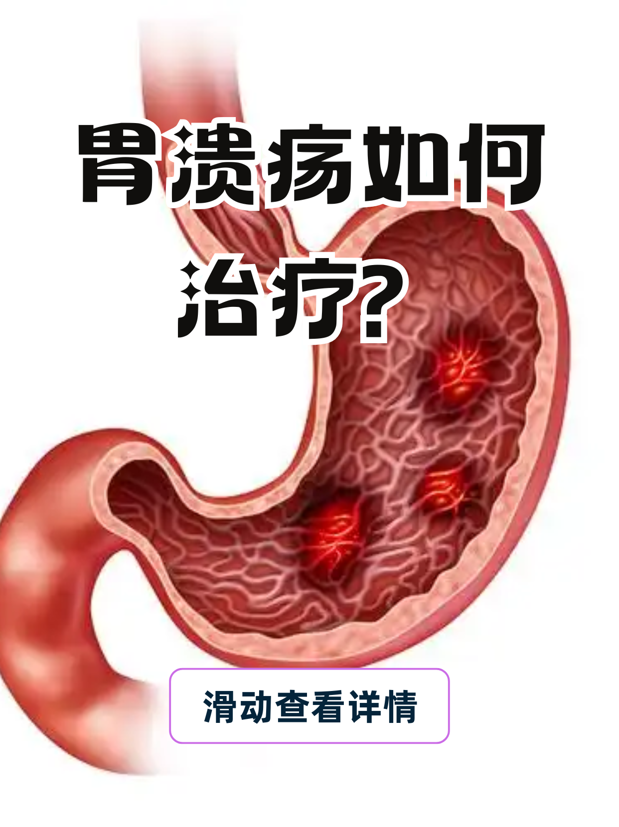 胃溃疡要怎么治疗