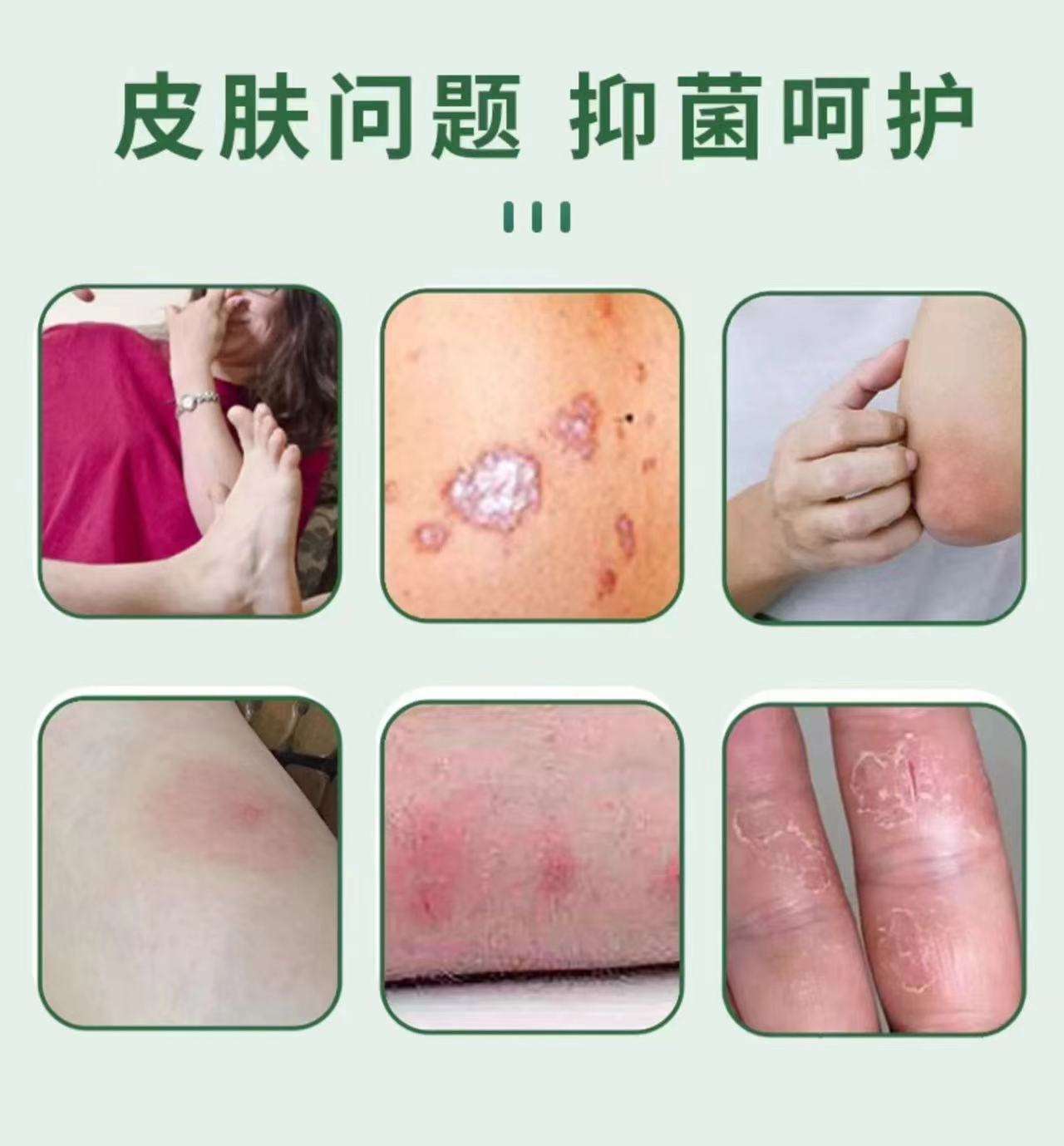 真菌性感染用什么药