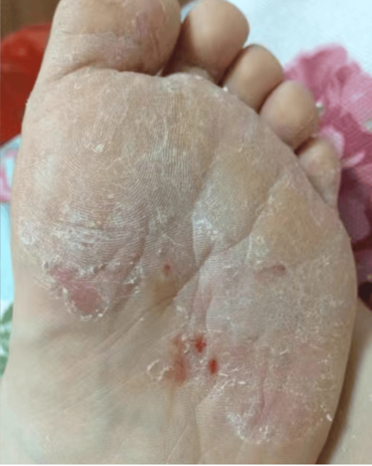 男足球运动员,有脚气,汗脚,脚特别臭