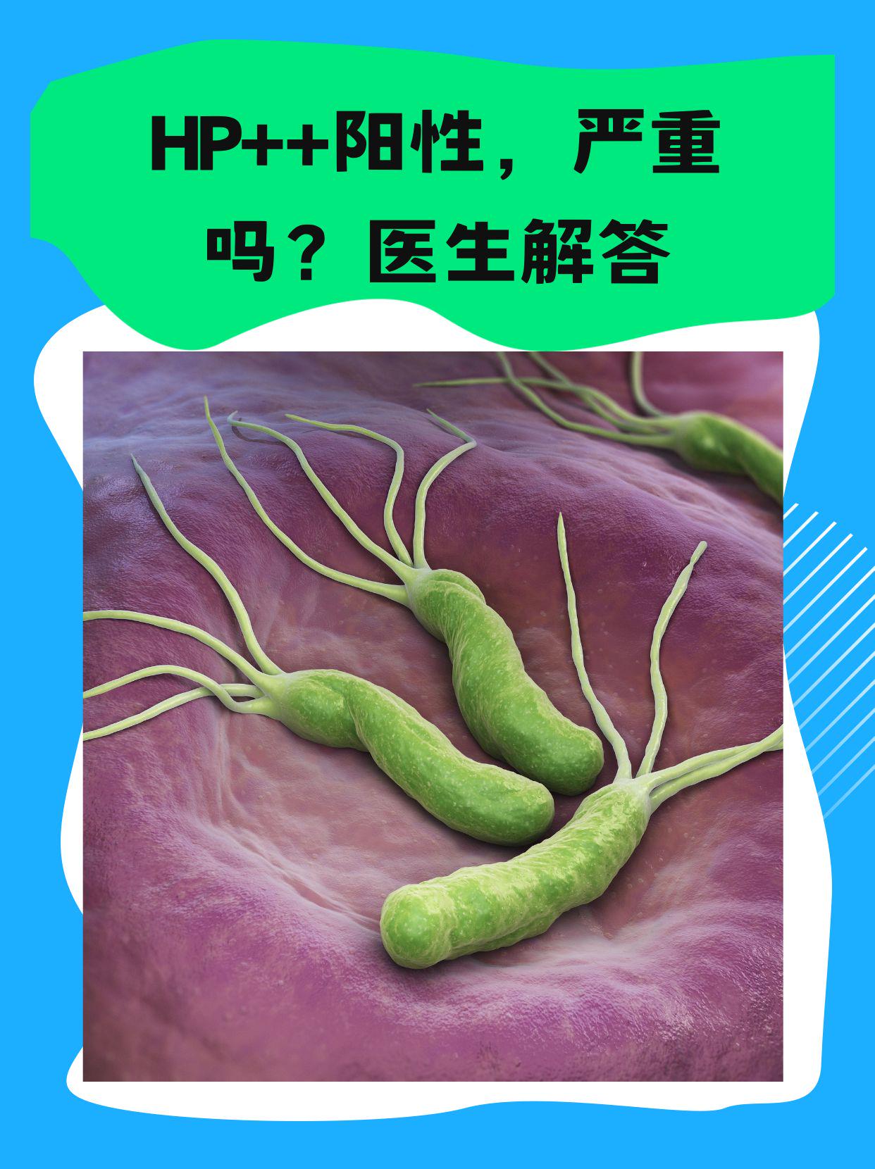 什么是幽门螺旋杆菌阳性?
