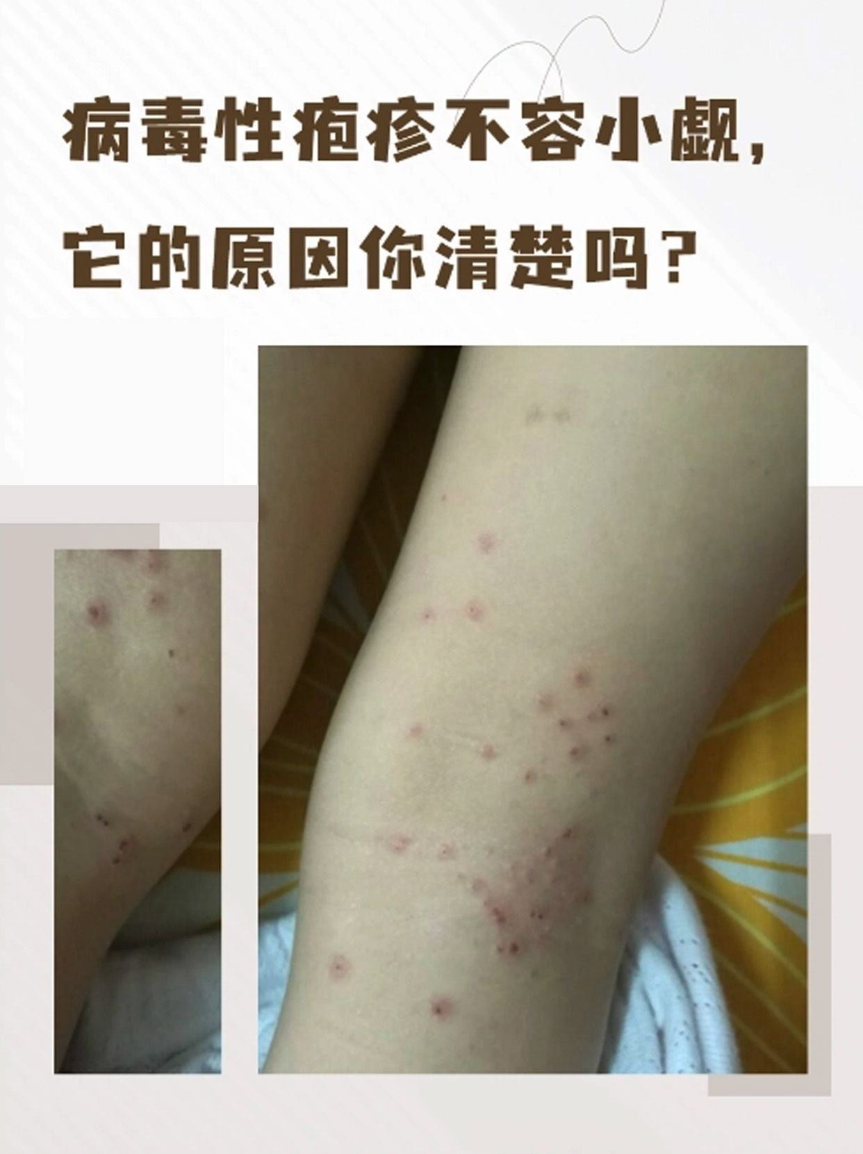 病毒性疱疹怎么治疗