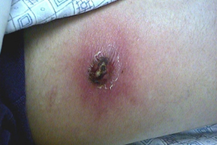 草爬子咬后什么症状