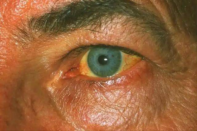 胰腺癌晚期的临死症状是什么