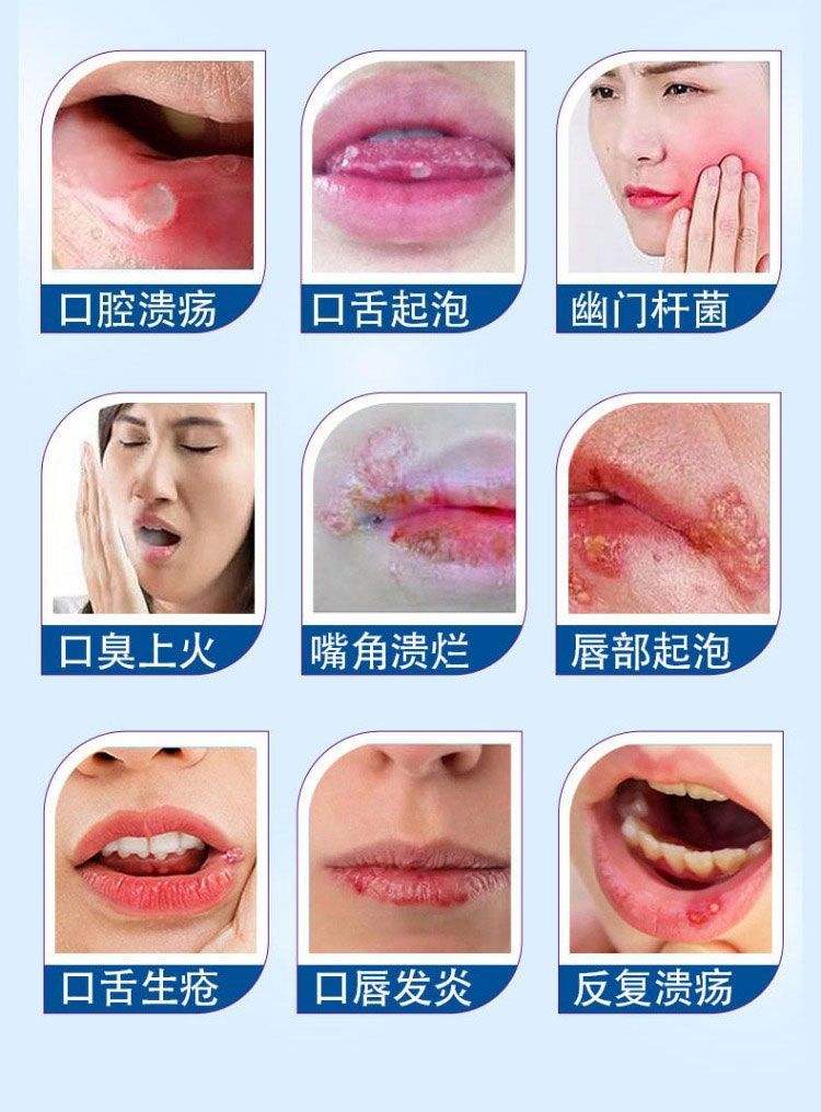嘴角溃烂用什么药