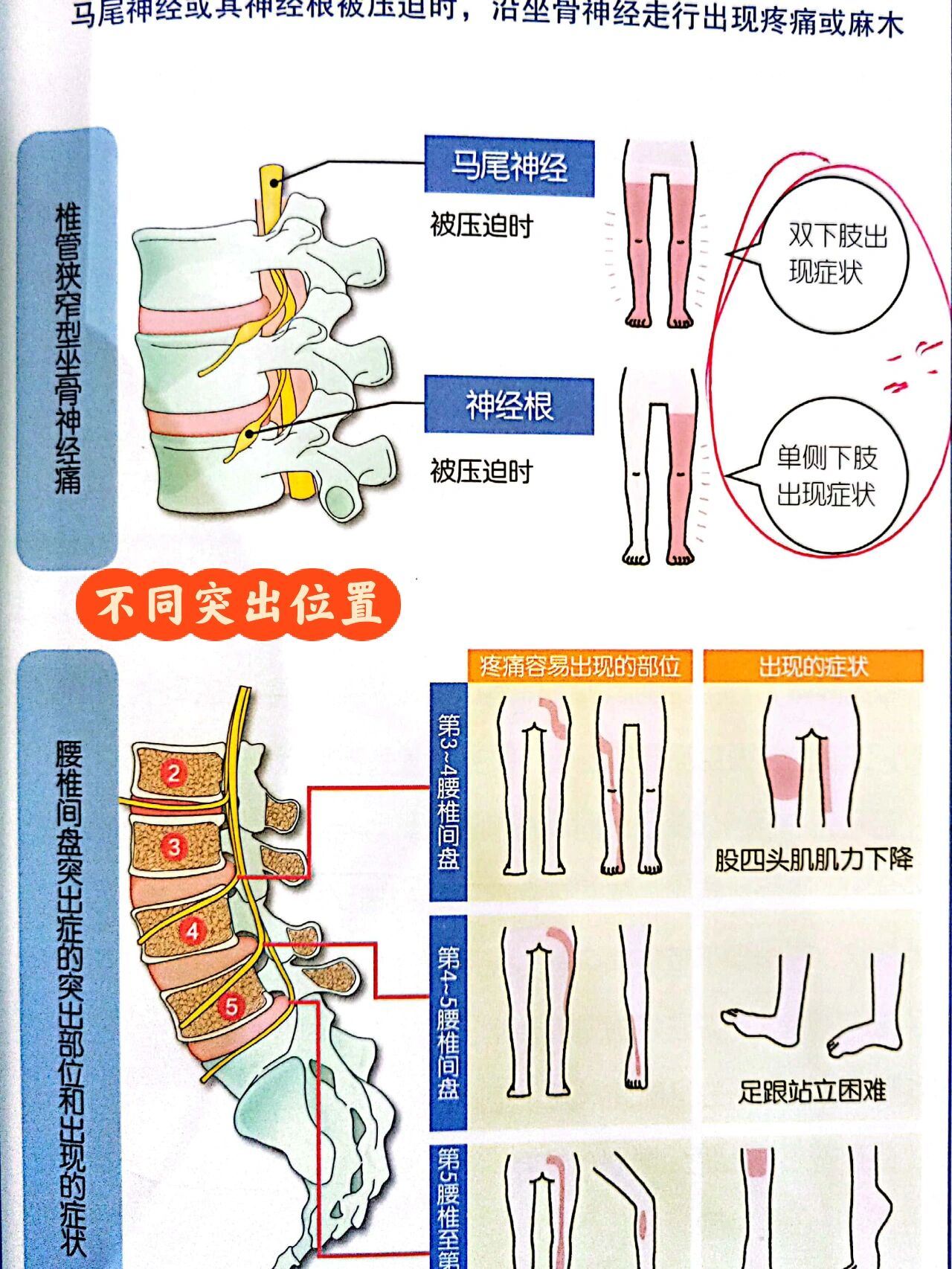 坐骨神经痛的症状表现