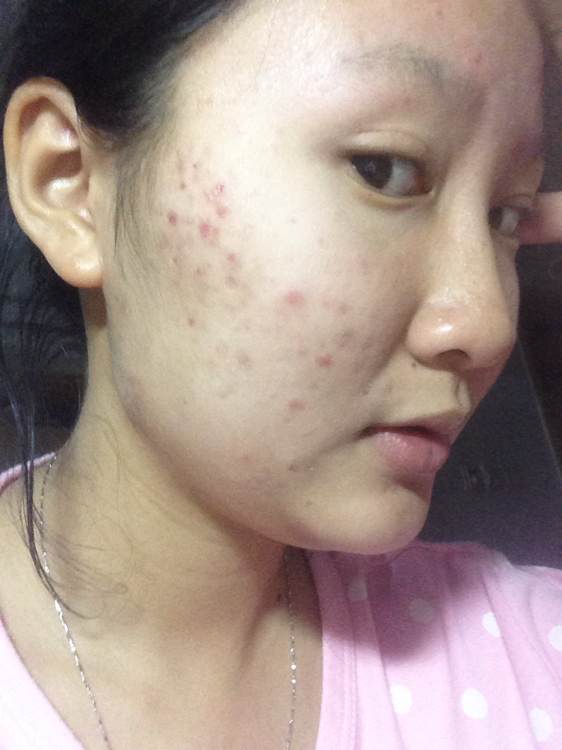 脸上长好多痘痘(如下图