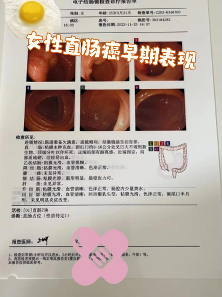 大便次数多还不成形是直肠癌吗
