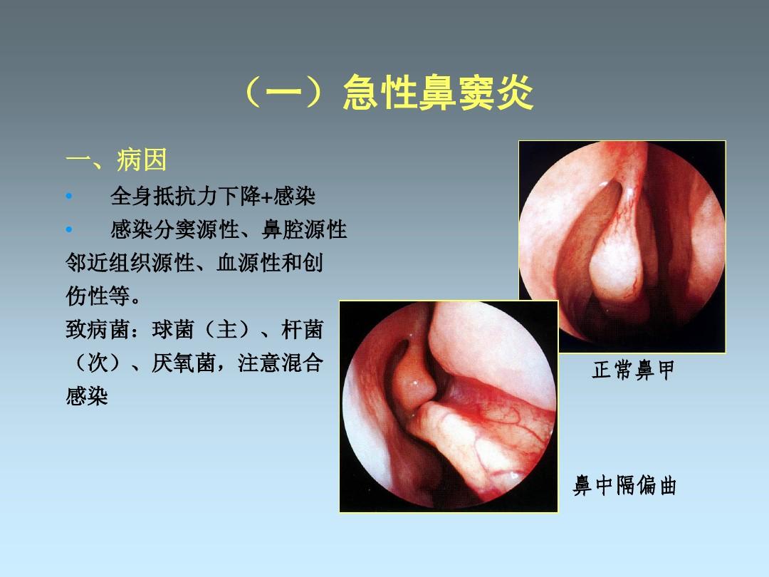 鼻炎都有哪些症状表现