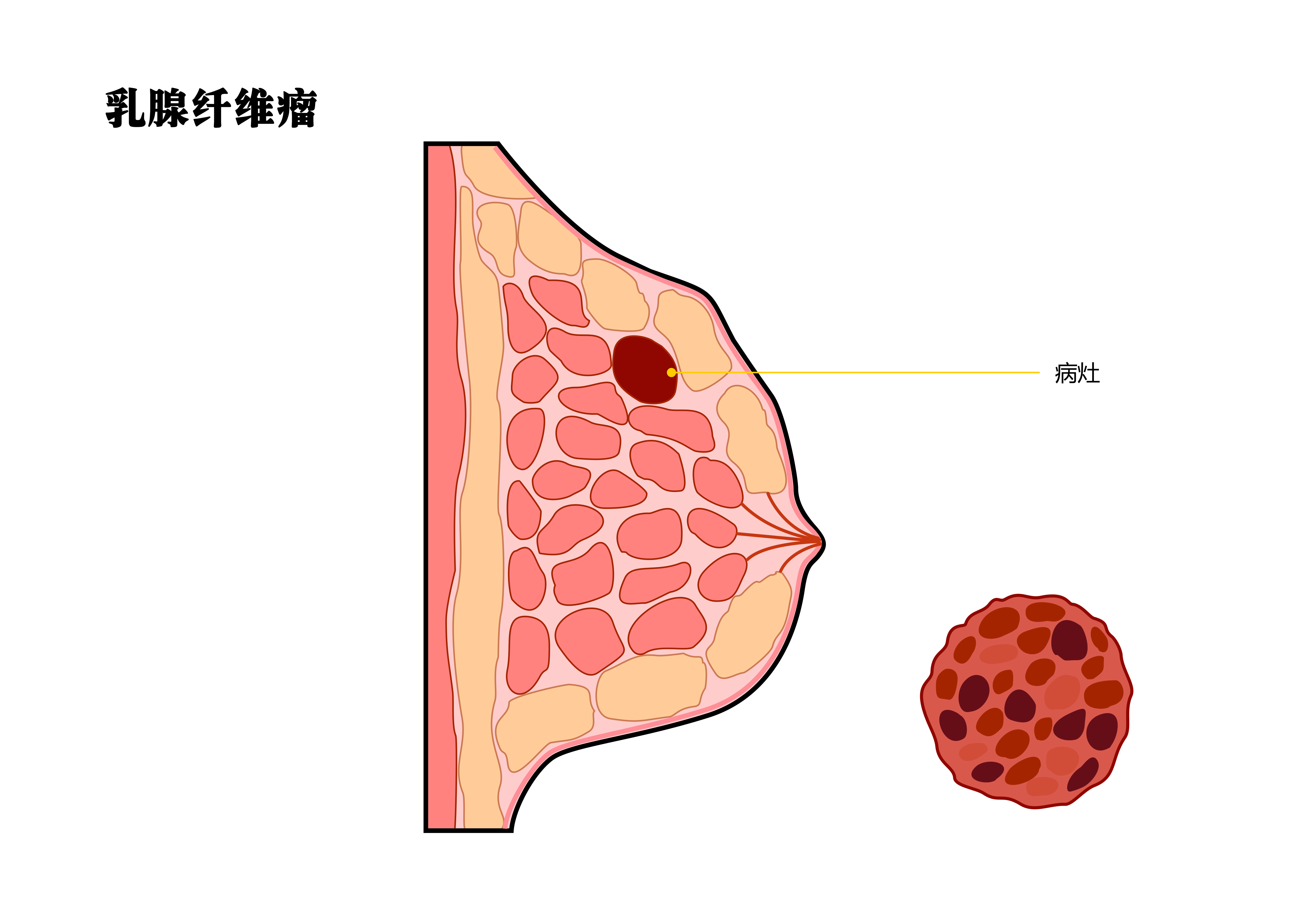 乳腺纤维瘤症状有哪些