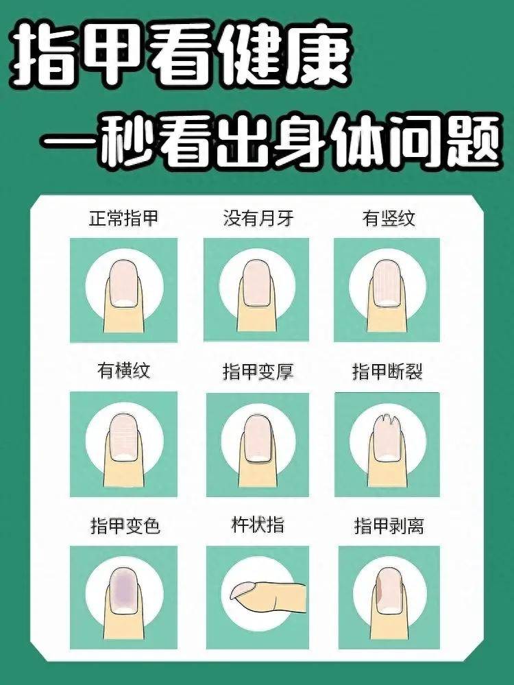 指甲有横纹怎么回事?