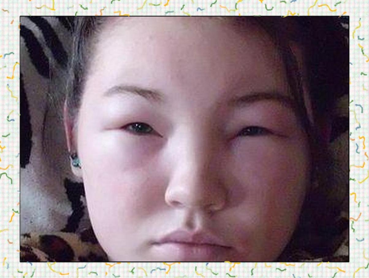 脸部浮肿是什么原因