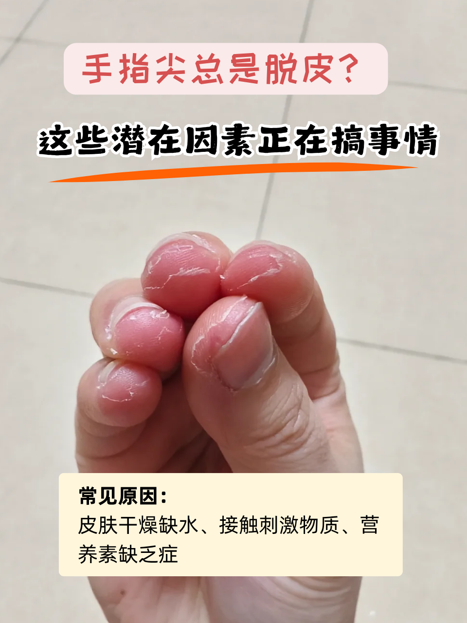 手指头脱皮,怎么回事