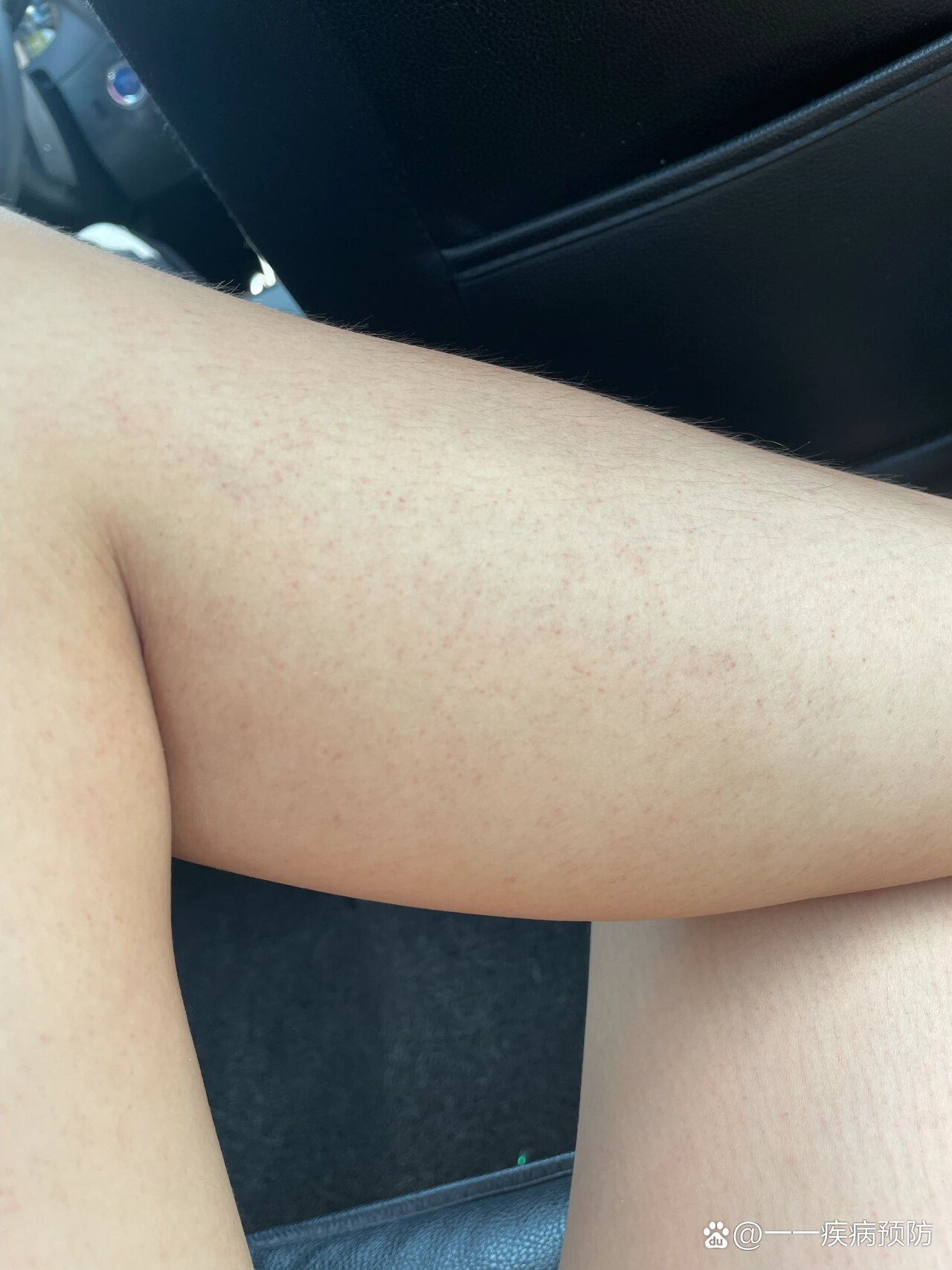 腿上小红点,不痛不痒