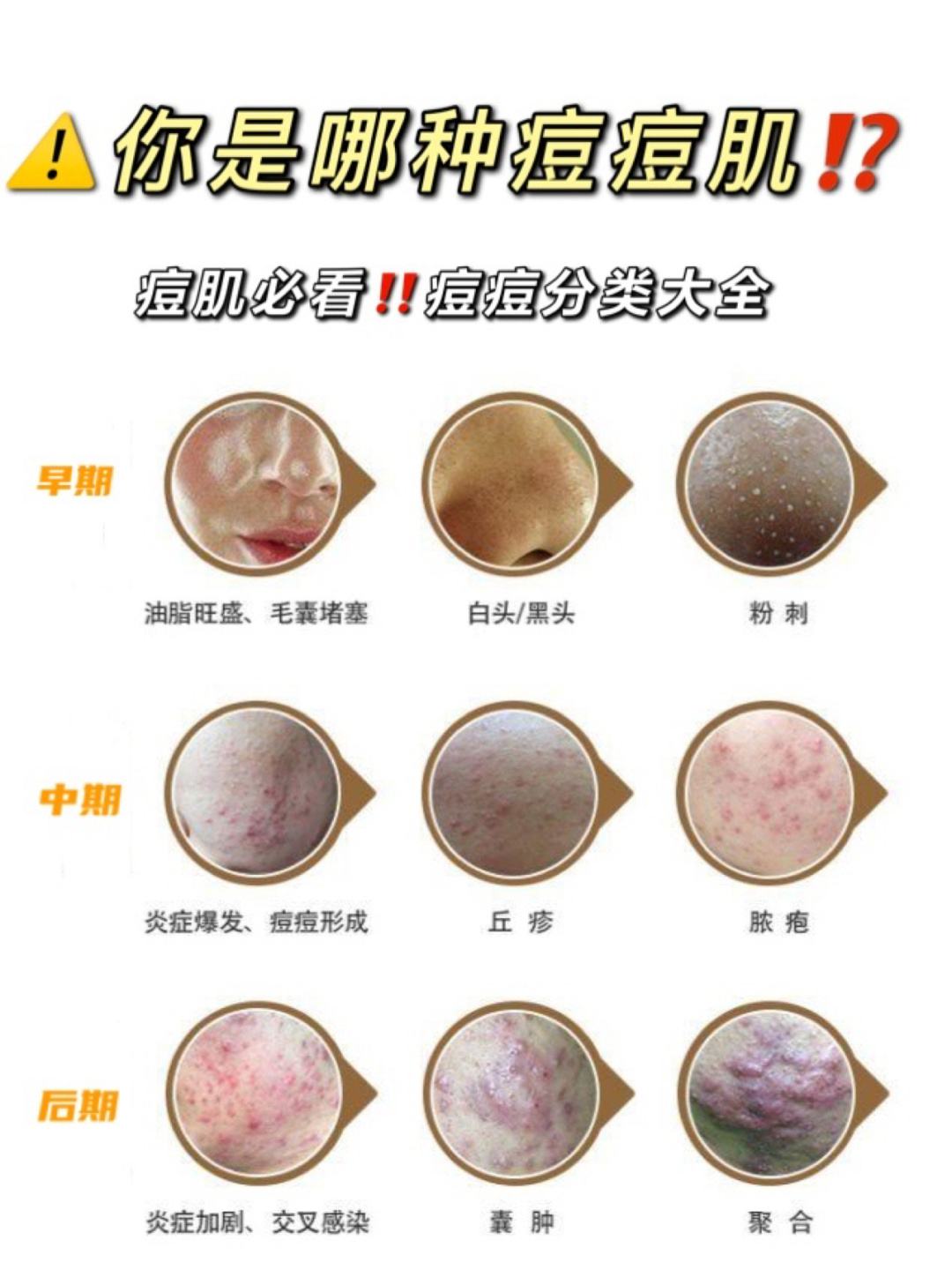 痤疮如何快速去除