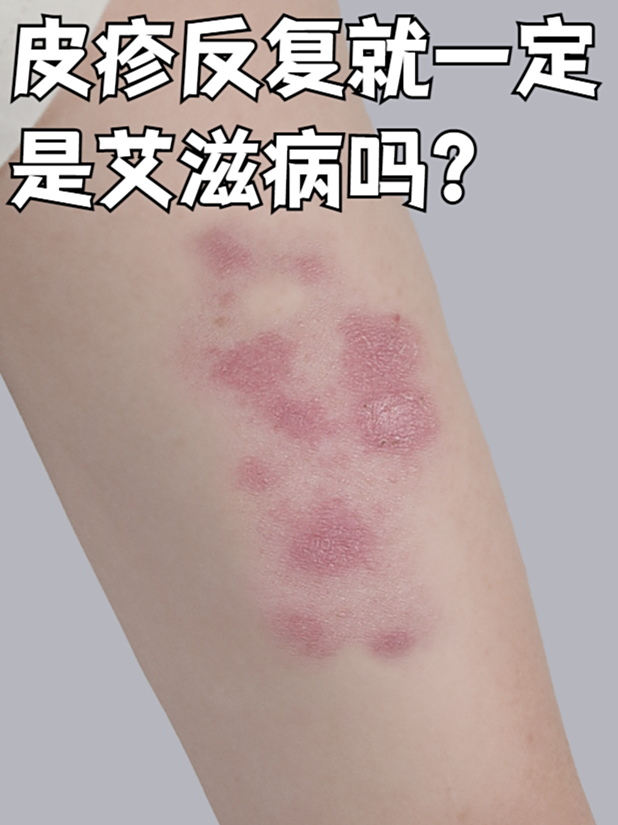 艾滋病皮疹会痒吗?