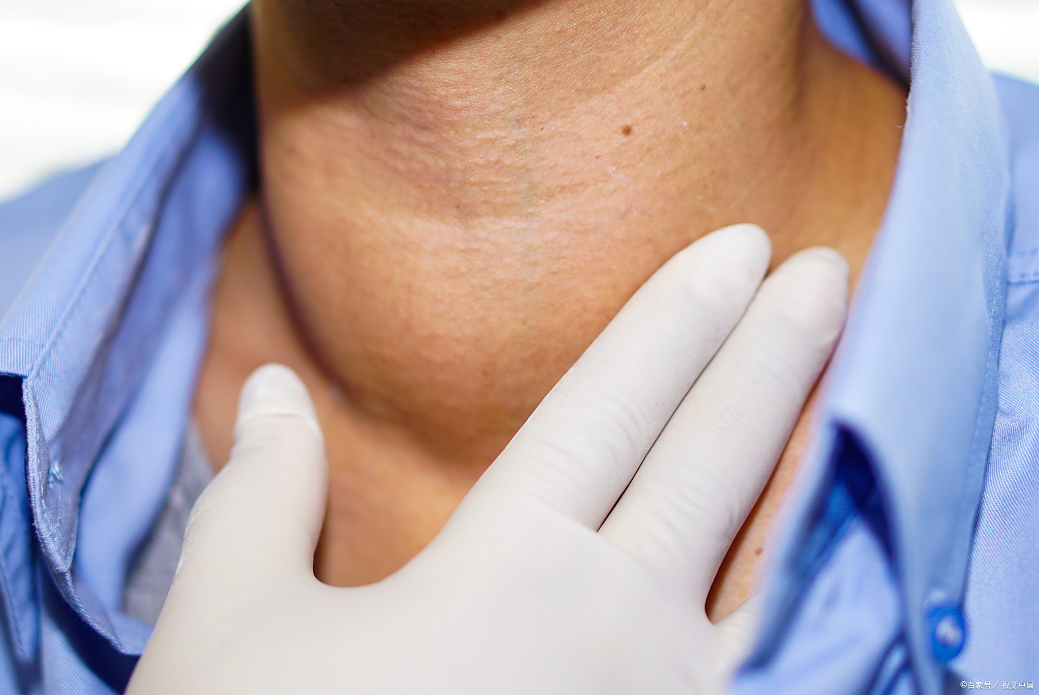 桥本氏甲状腺炎症状有哪些