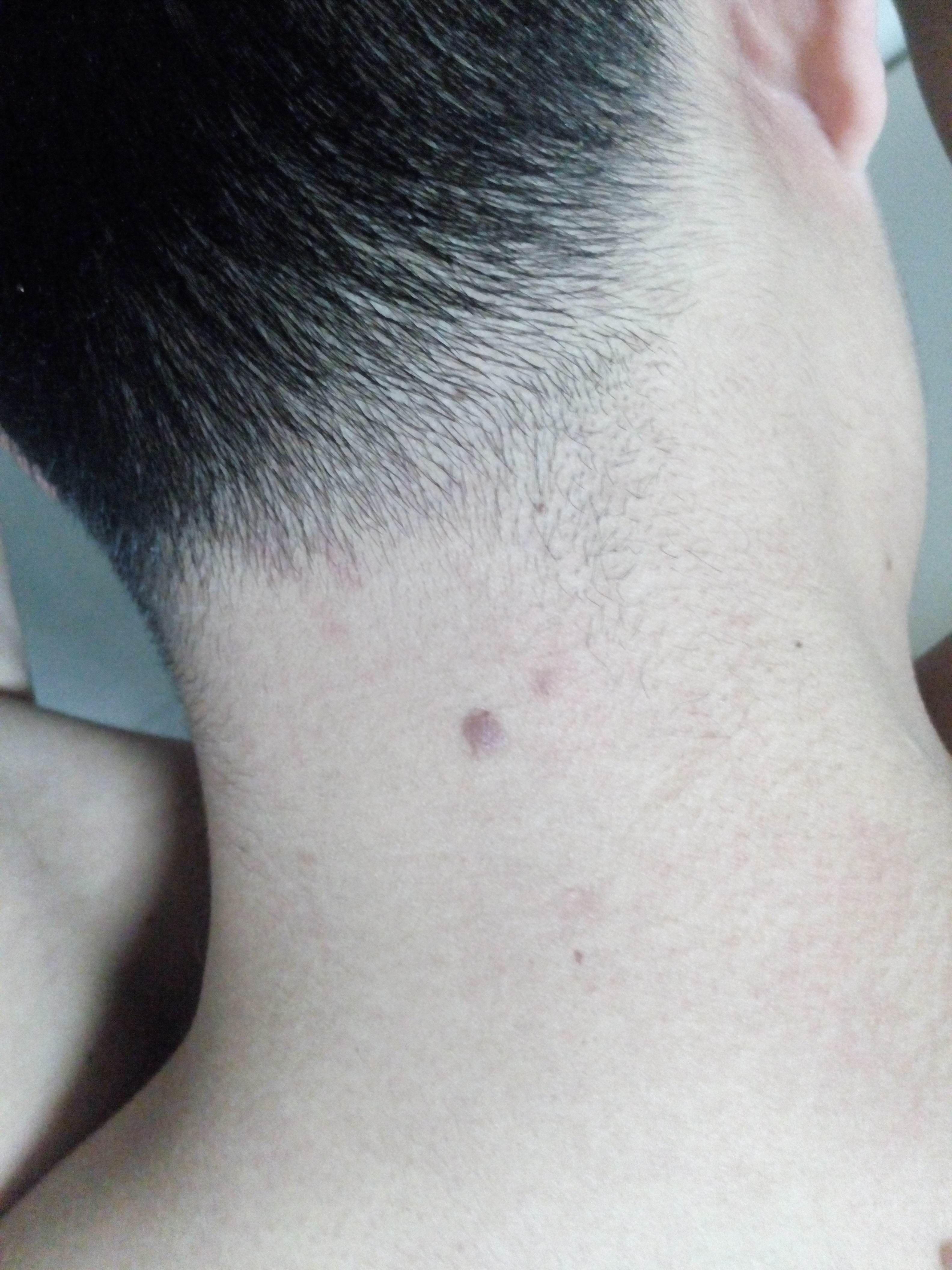 脖子后面长了一个硬包按压疼痛.