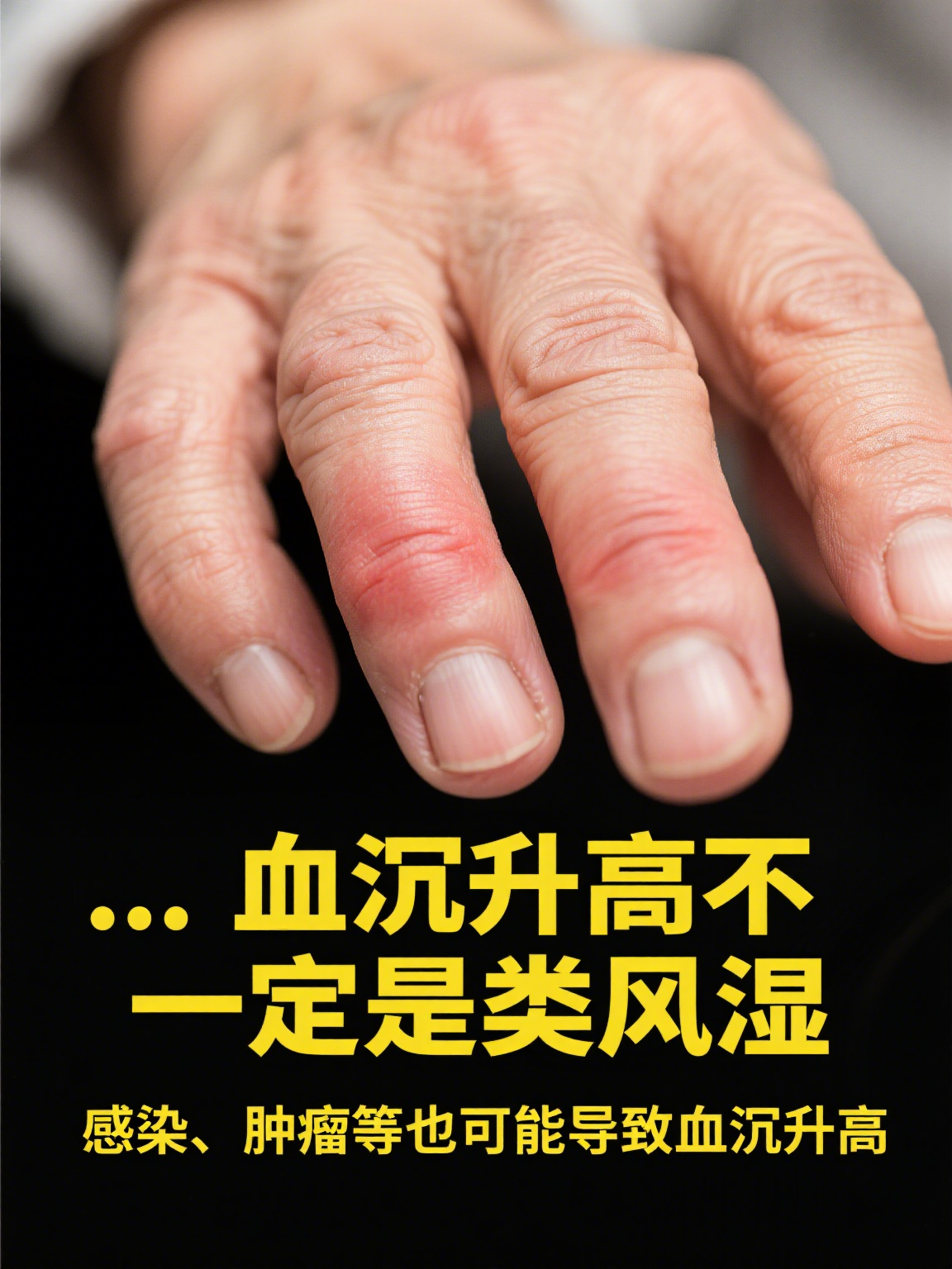 血沉高是风湿病吗