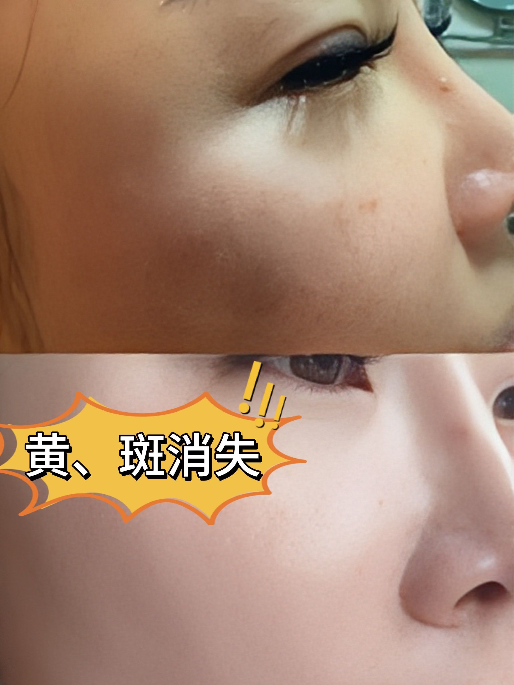 美白针多长时间打一次呢