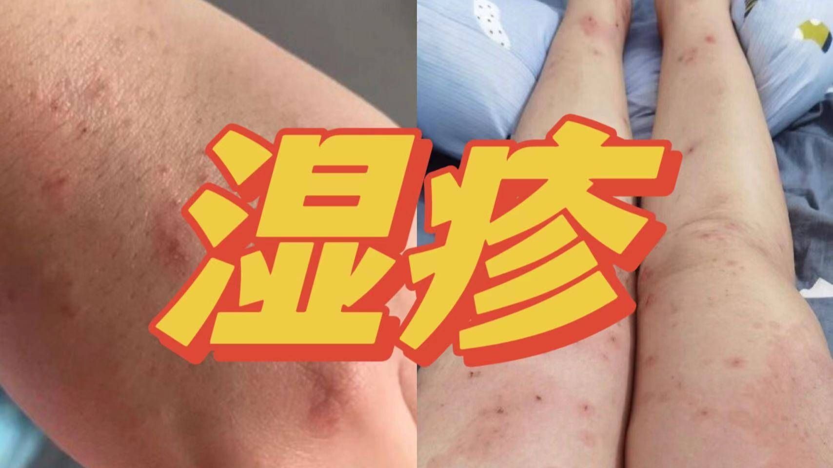 成人湿疹最好的治疗方法是什么?