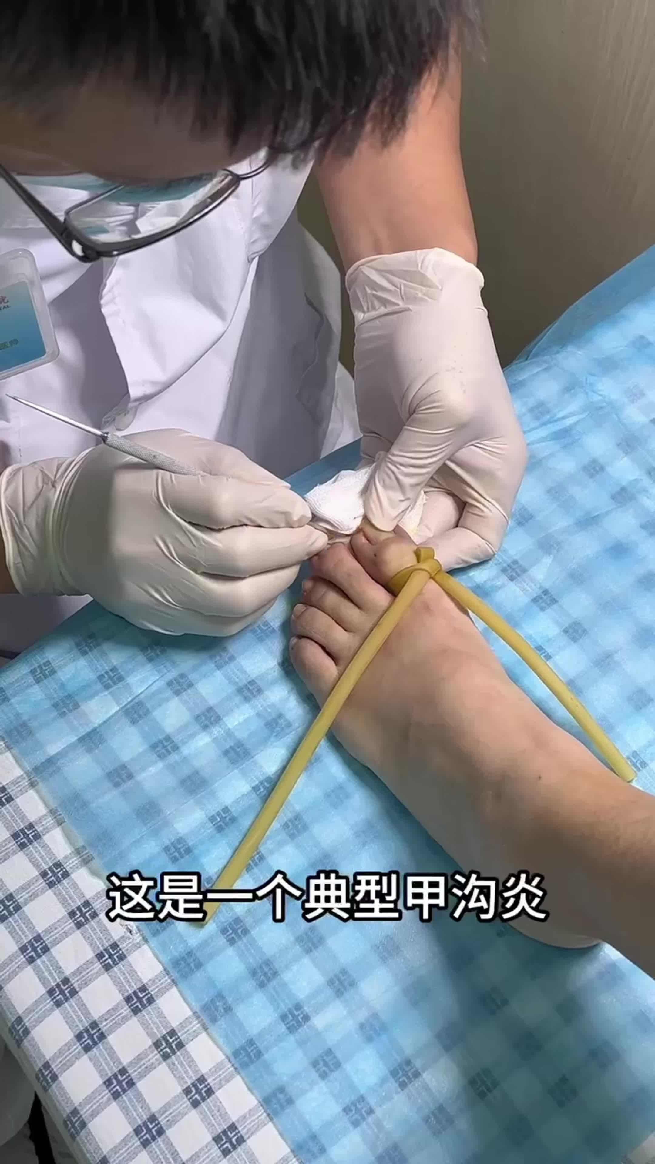 得了甲沟炎怎样治疗好得快