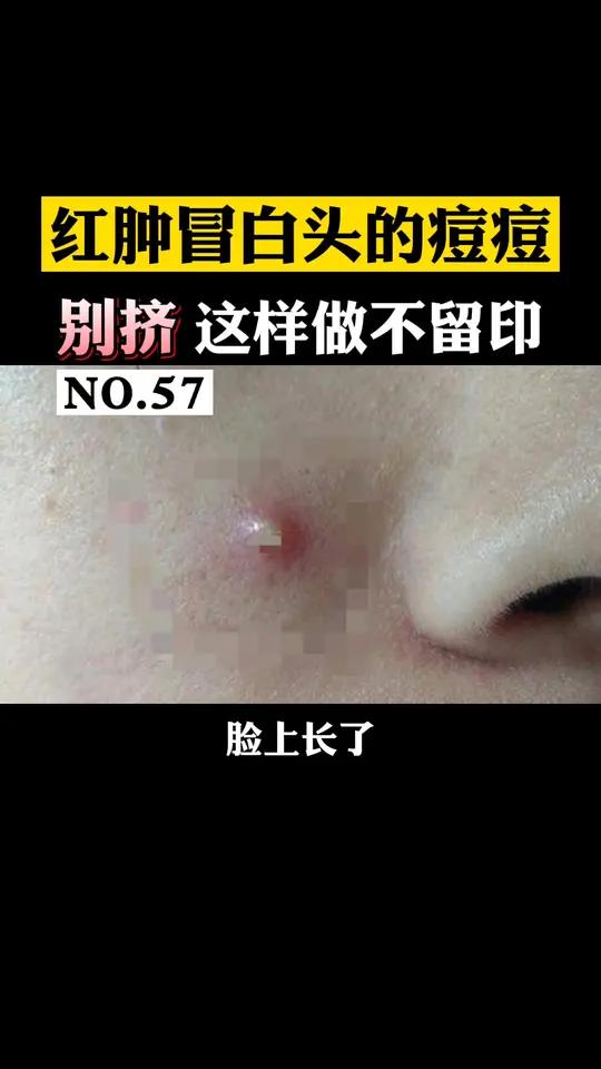 脓包型痘痘怎么治疗好