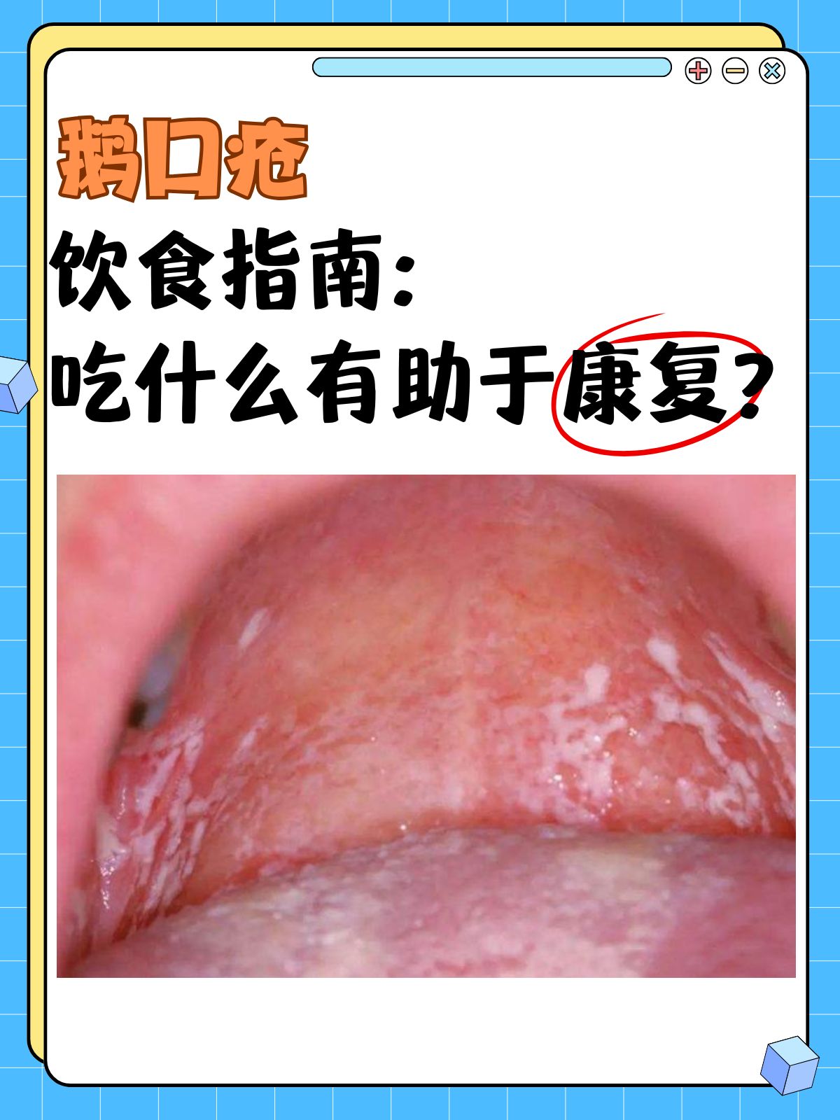 鹅口疮最佳治疗办法.