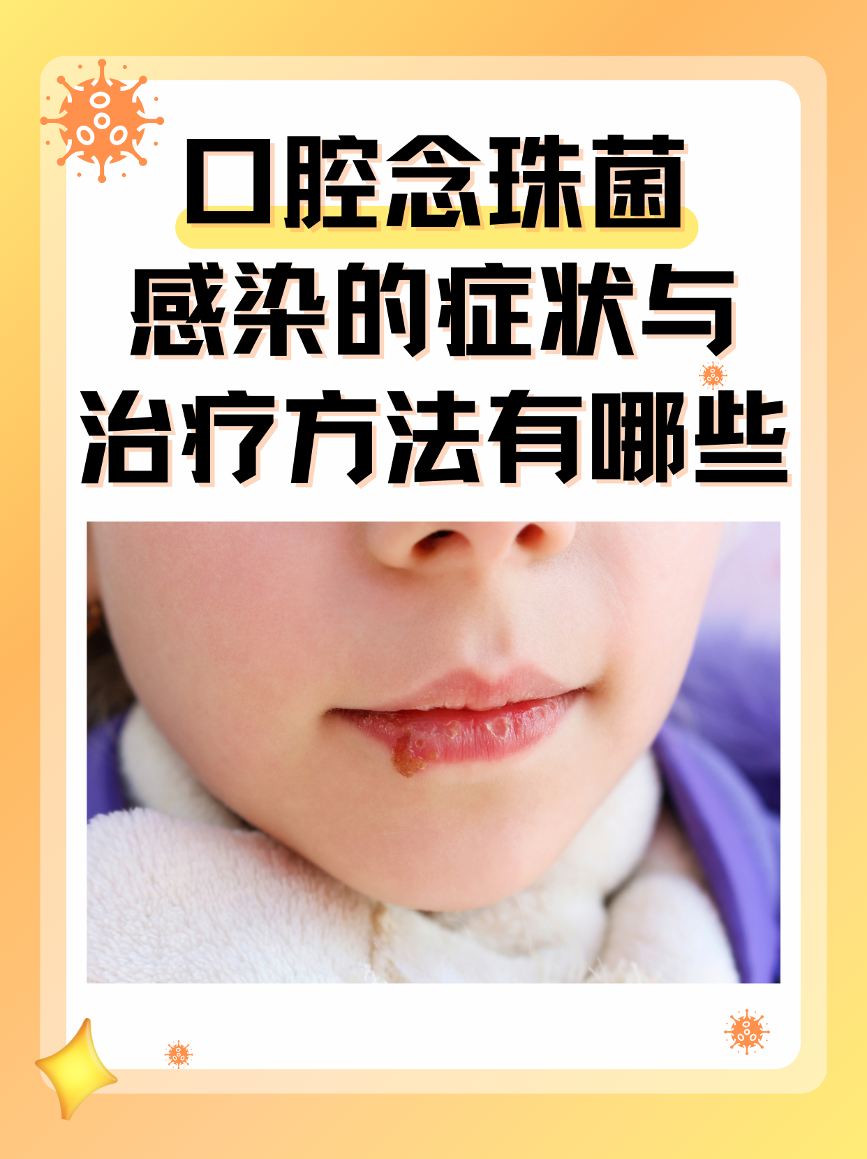 鹅口疮最佳治疗办法.
