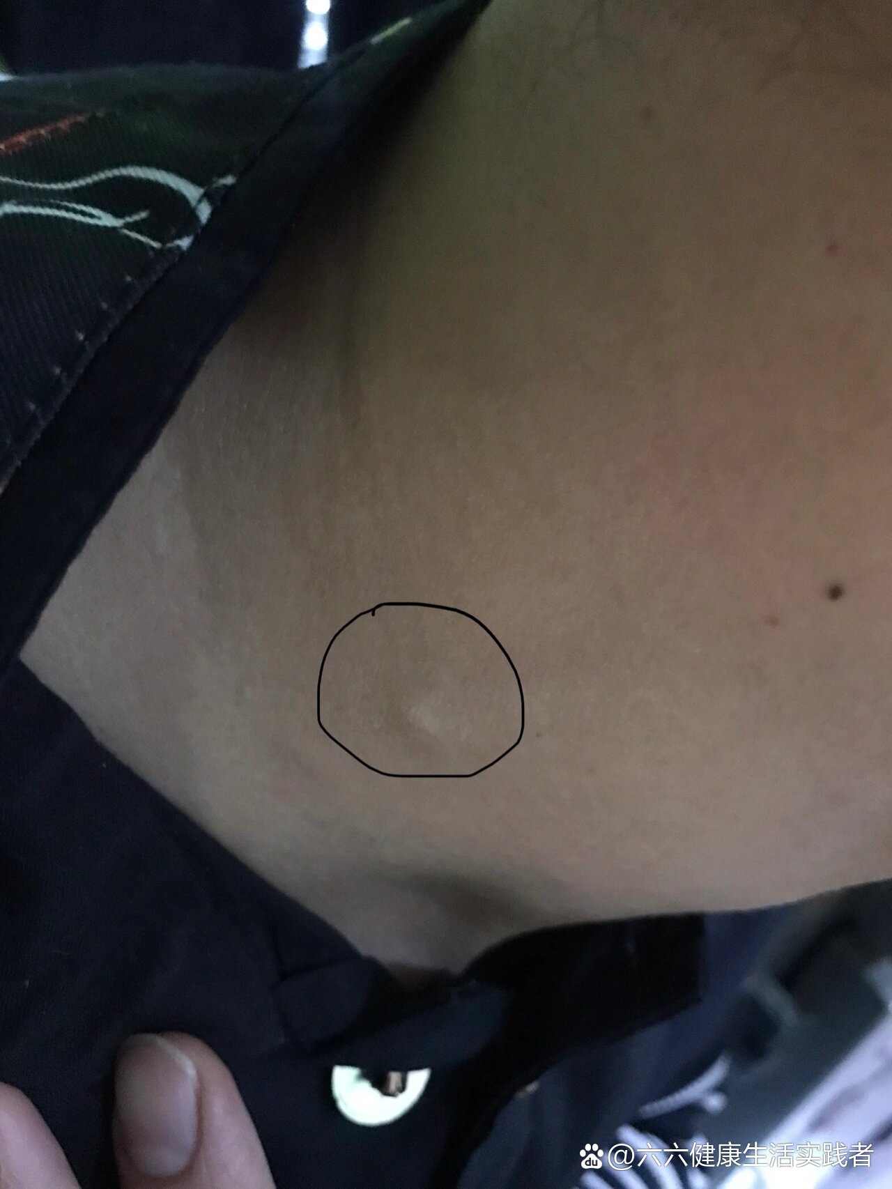 脖子左侧筋上有个疙瘩