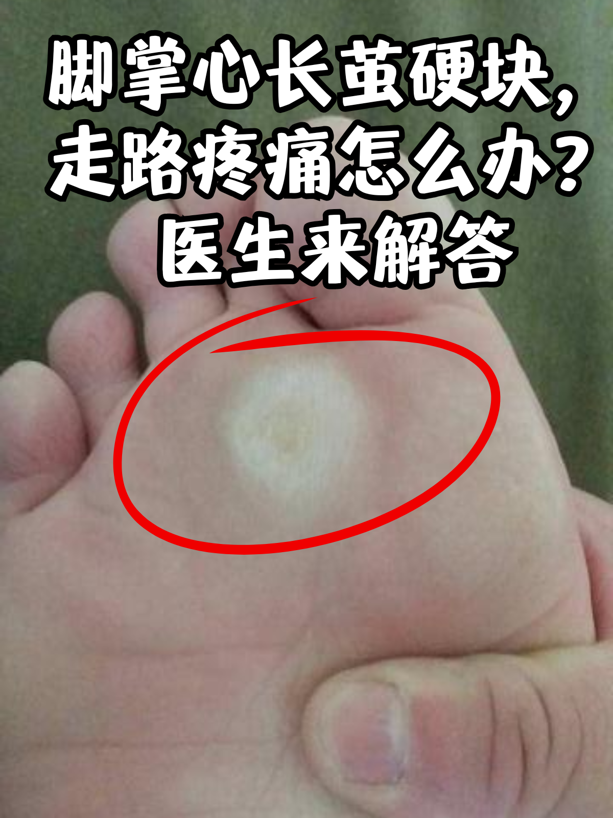 前脚掌为什么疼?