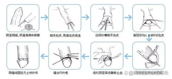 包皮环切术