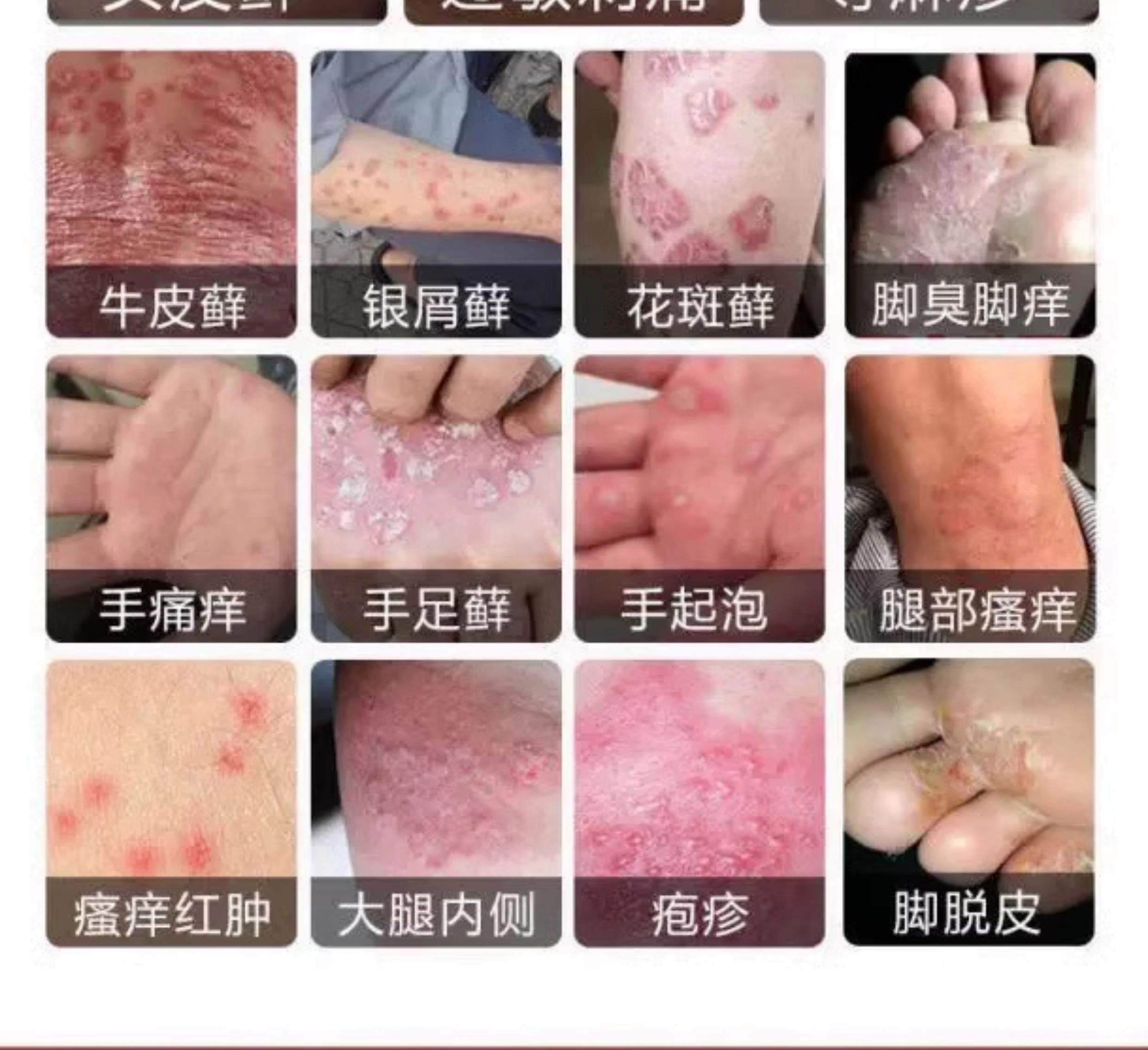 阴部瘙痒