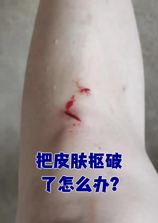 皮肤破损怎么办