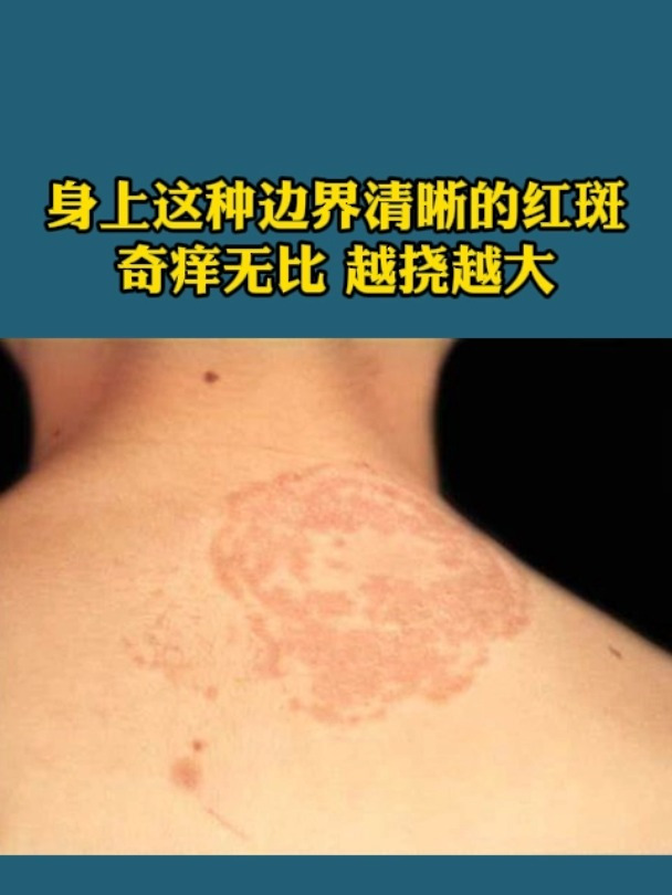 身上长红斑,很痒