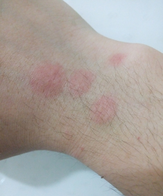 身上长红斑,很痒