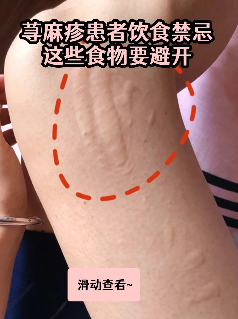 寻麻疹不能吃什么