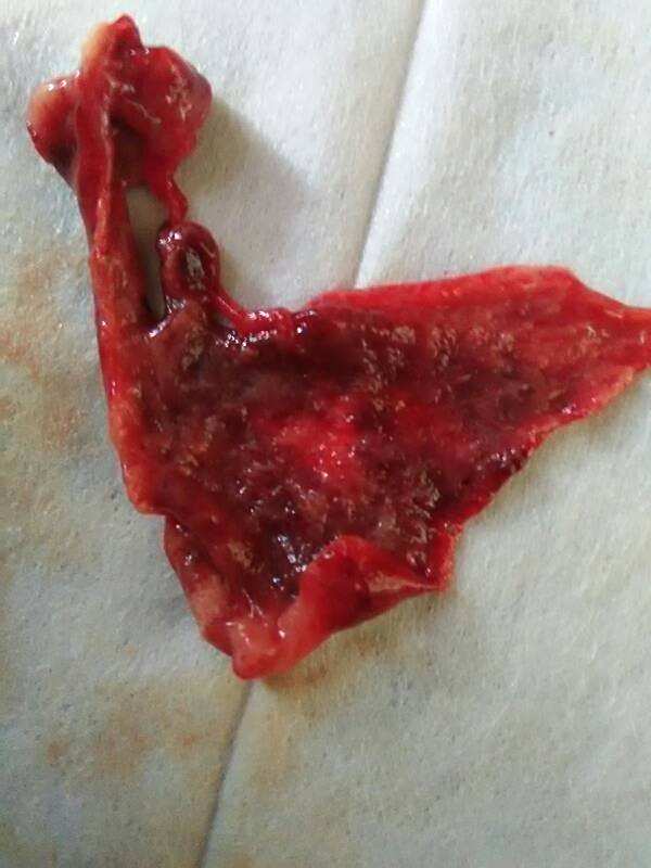 流产后流出的蜕膜是什么样子我已经药流7